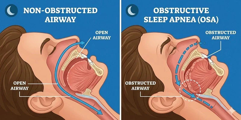 Obstructive Sleep Apnea