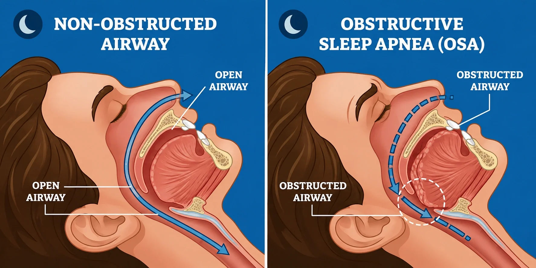 Obstructive Sleep Apnea
