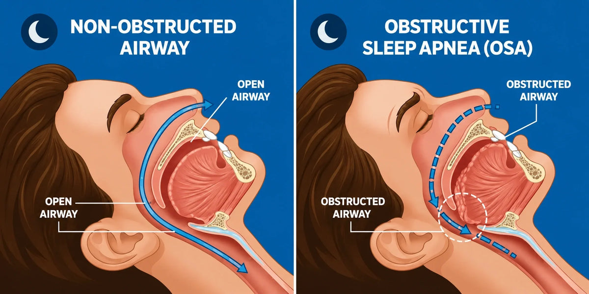 Obstructive Sleep Apnea